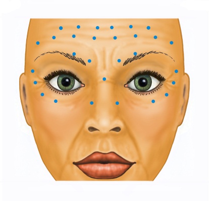 botox tm botox injection sites